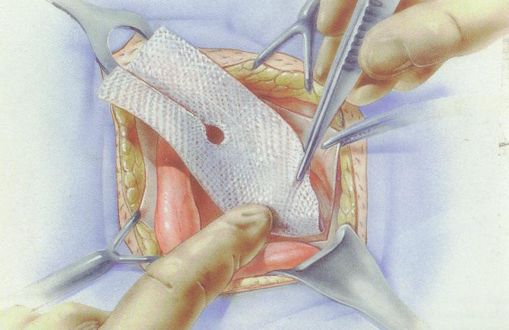 Hernia inghinala laparoscopica I Operatie hernie inghinala fara durere