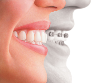 smile_with_invisalign